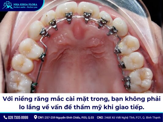 niềng răng cửa thưa - ảnh 5 niềng răng cửa thưa - ảnh 5