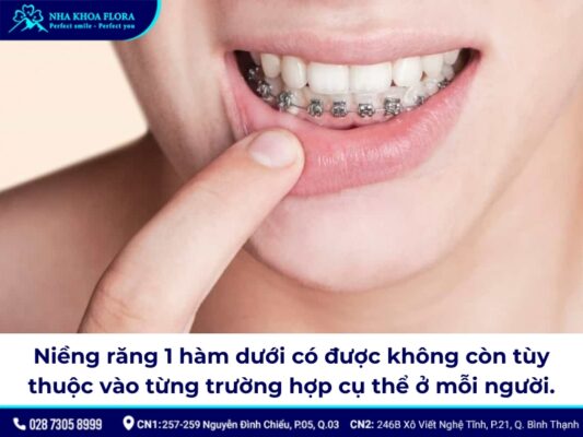 niềng răng hàm dưới - ảnh 1 niềng răng hàm dưới - ảnh 1