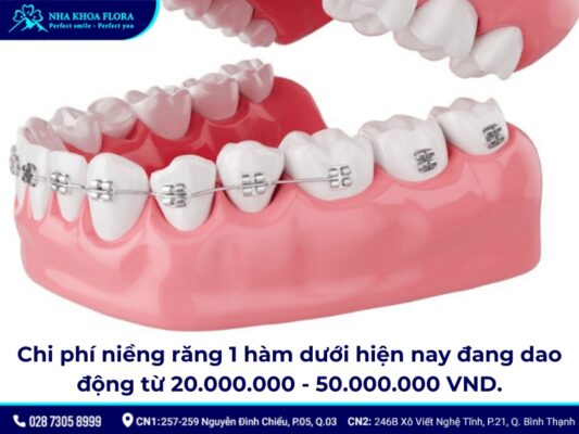 niềng răng hàm dưới - ảnh 4 niềng răng hàm dưới - ảnh 4