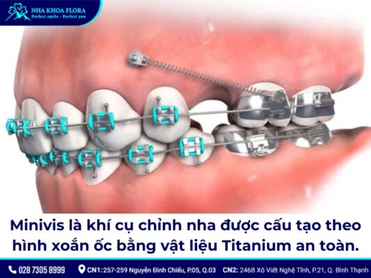 niềng răng minivis - ảnh 1 niềng răng minivis - ảnh 1