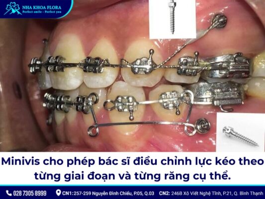 niềng răng minivis - ảnh 2 niềng răng minivis - ảnh 2