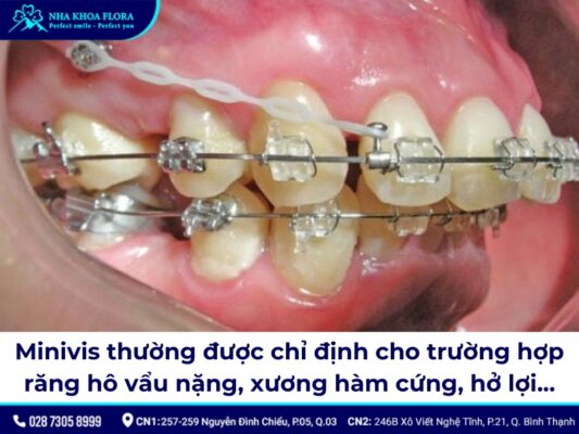 niềng răng minivis - ảnh 3 niềng răng minivis - ảnh 3