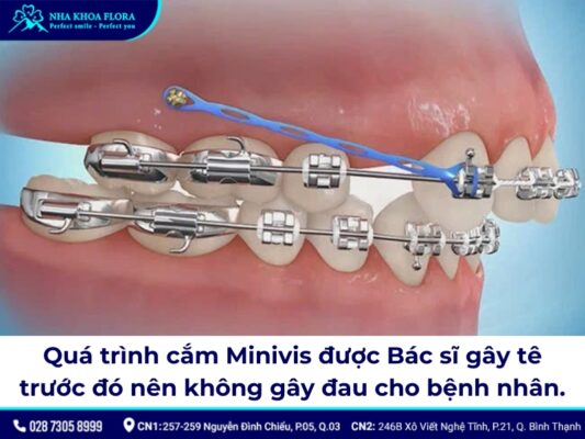 niềng răng minivis - ảnh 4 niềng răng minivis - ảnh 4