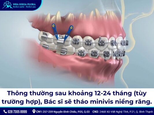 niềng răng minivis - ảnh 5 niềng răng minivis - ảnh 5