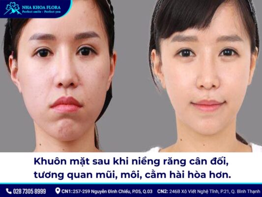 niềng răng mũi có cao lên không - ảnh 2 niềng răng mũi có cao lên không - ảnh 2