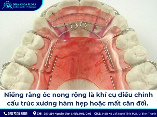 niềng răng ốc nong rộng - ảnh 1 niềng răng ốc nong rộng - ảnh 1