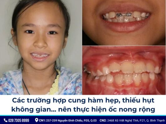 niềng răng ốc nong rộng - ảnh 2 niềng răng ốc nong rộng - ảnh 2