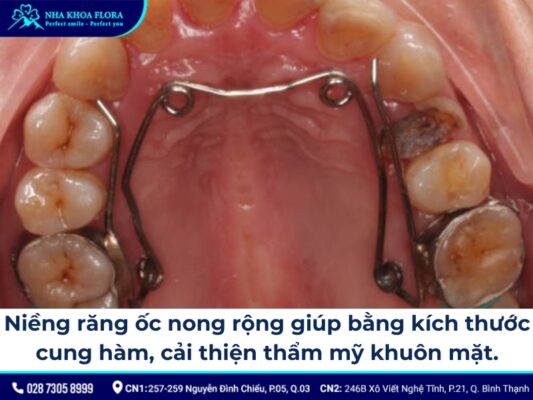 niềng răng ốc nong rộng - ảnh 3 niềng răng ốc nong rộng - ảnh 3
