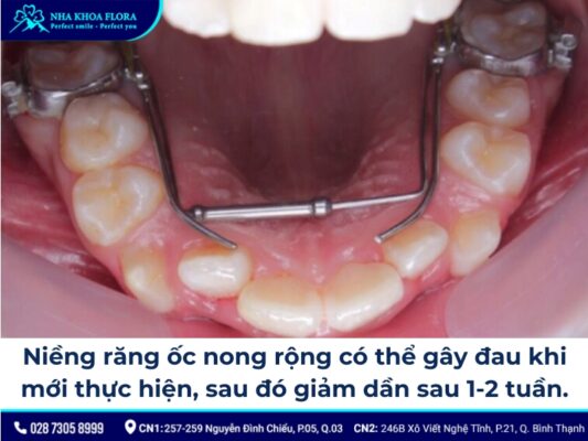 niềng răng ốc nong rộng - ảnh 4 niềng răng ốc nong rộng - ảnh 4