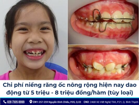 niềng răng ốc nong rộng - ảnh 5 niềng răng ốc nong rộng - ảnh 5