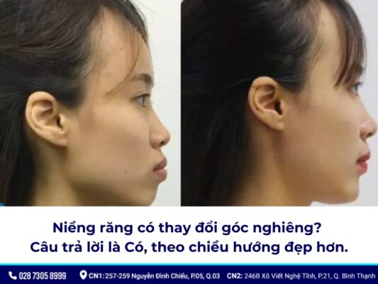 niềng răng thay đổi góc nghiêng - ảnh 1 niềng răng thay đổi góc nghiêng - ảnh 1