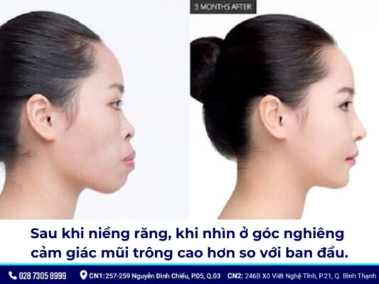 niềng răng thay đổi góc nghiêng - ảnh 2 niềng răng thay đổi góc nghiêng - ảnh 2