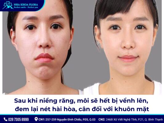 niềng răng thay đổi góc nghiêng - ảnh 3 niềng răng thay đổi góc nghiêng - ảnh 3