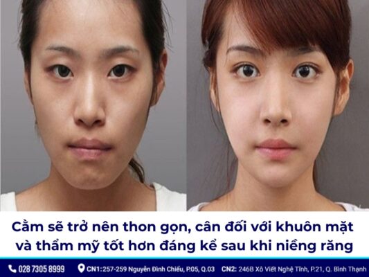 niềng răng thay đổi góc nghiêng - ảnh 4 niềng răng thay đổi góc nghiêng - ảnh 4