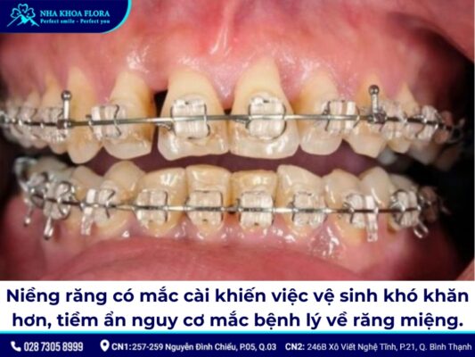 tác hại của niềng răng - ảnh 1 tác hại của niềng răng - ảnh 1