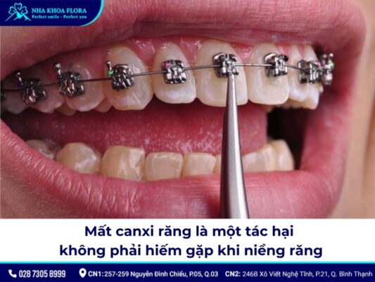 tác hại của niềng răng - ảnh 3 tác hại của niềng răng - ảnh 3