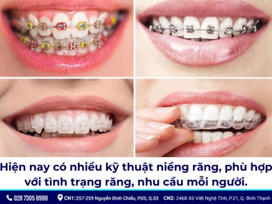 30 tuổi có niềng răng được không - ảnh 2 30 tuổi có niềng răng được không - ảnh 2