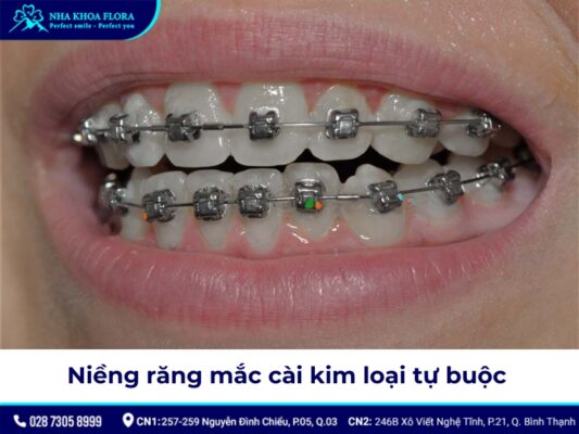 40 tuổi có niềng răng được không - ảnh 3 40 tuổi có niềng răng được không - ảnh 3