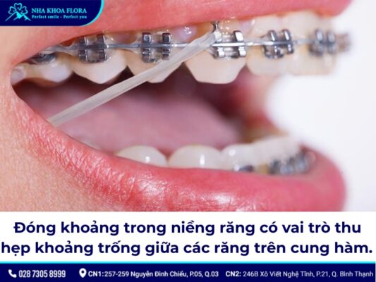 đóng khoảng trong niềng răng – ảnh 1 đóng khoảng trong niềng răng – ảnh 1