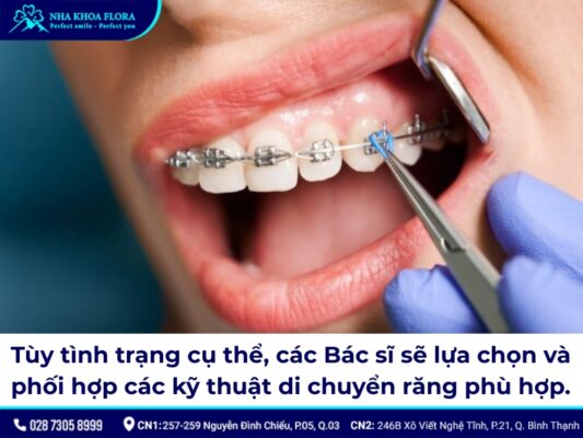 đóng khoảng trong niềng răng – ảnh 2 đóng khoảng trong niềng răng – ảnh 2