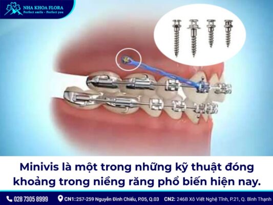 đóng khoảng trong niềng răng – ảnh 3 đóng khoảng trong niềng răng – ảnh 3