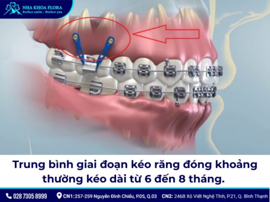 đóng khoảng trong niềng răng – ảnh 4 đóng khoảng trong niềng răng – ảnh 4