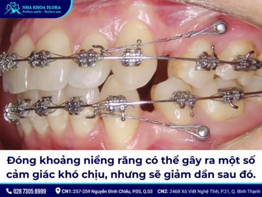 đóng khoảng trong niềng răng – ảnh 5 đóng khoảng trong niềng răng – ảnh 5