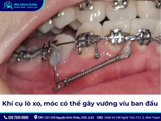 đóng khoảng trong niềng răng – ảnh 6 đóng khoảng trong niềng răng – ảnh 6