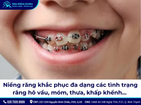 giá niềng răng cho trẻ 10 tuổi - ảnh 3 giá niềng răng cho trẻ 10 tuổi - ảnh 3