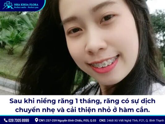 kết quả niềng răng sau 1 tháng - ảnh 1 kết quả niềng răng sau 1 tháng - ảnh 1