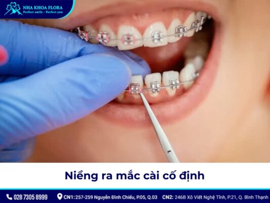 niềng răng cho trẻ 12 tuổi - ảnh 3 niềng răng cho trẻ 12 tuổi - ảnh 3