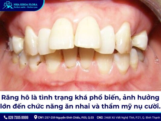 niềng răng hô tại nhà - ảnh 1 niềng răng hô tại nhà - ảnh 1