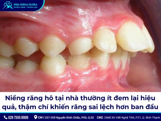 niềng răng hô tại nhà - ảnh 10 niềng răng hô tại nhà - ảnh 10