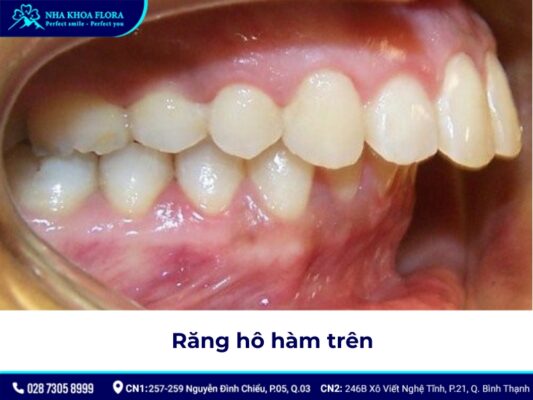 niềng răng hô tại nhà - ảnh 2 niềng răng hô tại nhà - ảnh 2