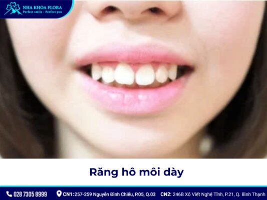 niềng răng hô tại nhà - ảnh 3 niềng răng hô tại nhà - ảnh 3