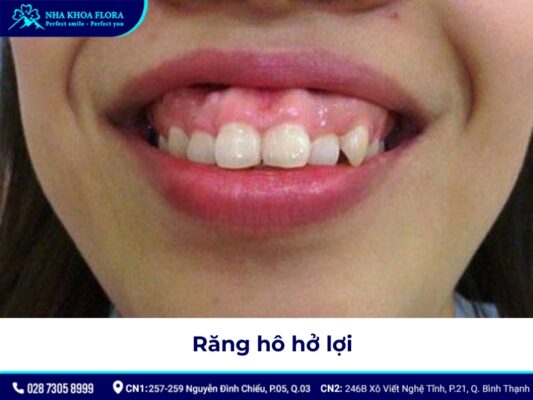 niềng răng hô tại nhà - ảnh 4 niềng răng hô tại nhà - ảnh 4