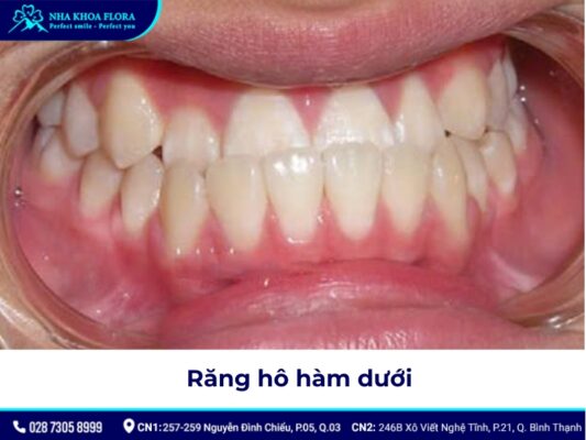 niềng răng hô tại nhà - ảnh 5 niềng răng hô tại nhà - ảnh 5