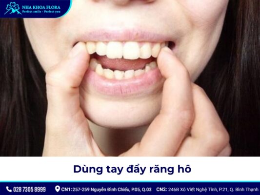 niềng răng hô tại nhà - ảnh 8 niềng răng hô tại nhà - ảnh 8