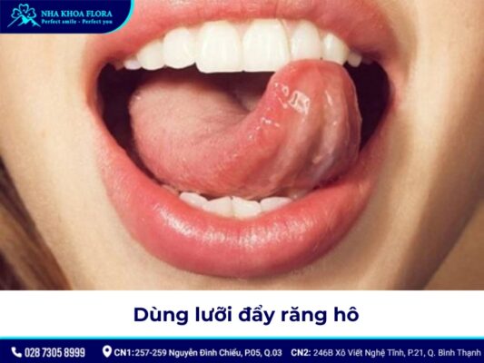 niềng răng hô tại nhà - ảnh 9 niềng răng hô tại nhà - ảnh 9