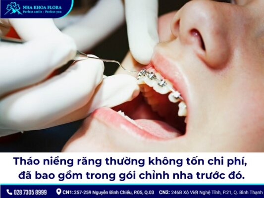 tháo niềng răng - ảnh 4 tháo niềng răng - ảnh 4
