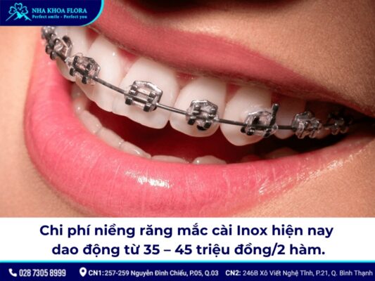 niềng răng inox đơn giản - ảnh 5 niềng răng inox đơn giản - ảnh 5