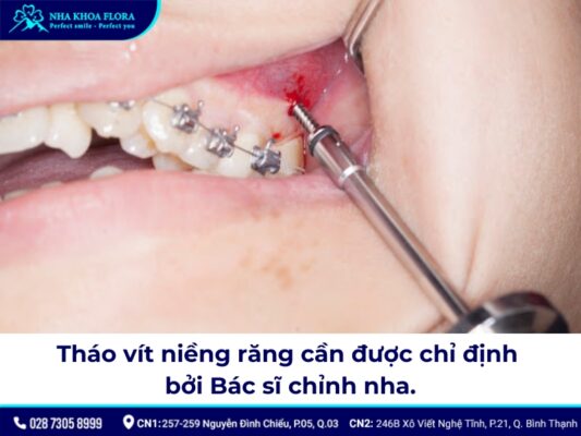 tháo vít niềng răng - ảnh 2 tháo vít niềng răng - ảnh 2
